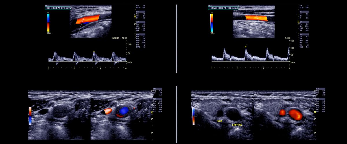 Ultrasonido Doppler