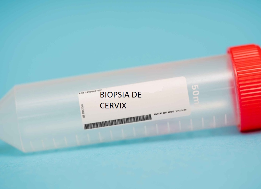 Biopsia de Cérvix